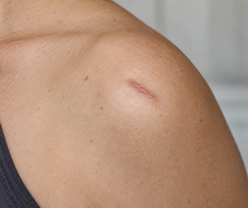This image depicts a small raised scar on the shoulder.
