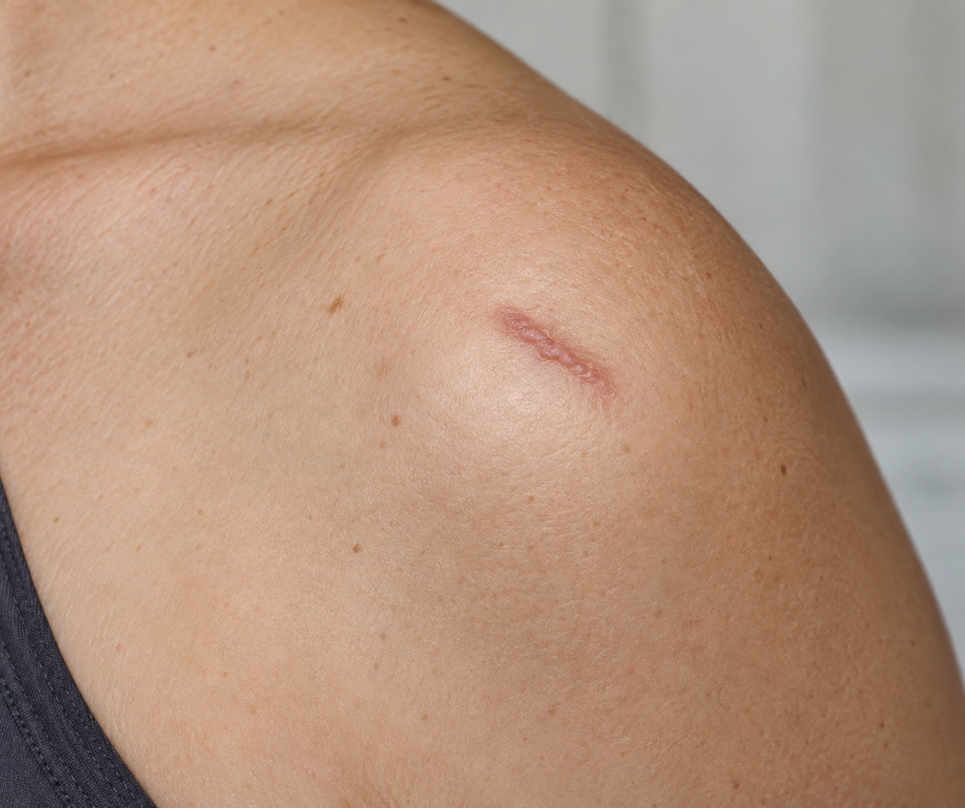 This image depicts a small raised scar on the shoulder.